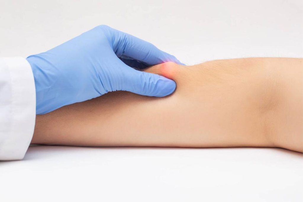 غده چربی یا لیپوم