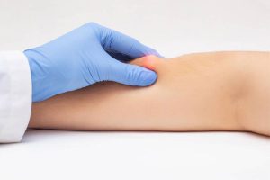 غده چربی یا لیپوم