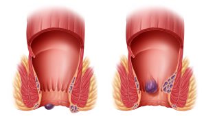 علائم بواسیر یا هموروئید