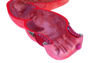 عمل شقاق با لیزر در تهران