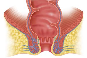 درمان آبسه مقعدی با لیزر