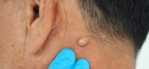 درمان لیپوم با لیزر در تهران