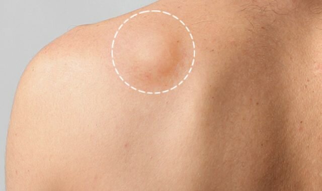 جراحی لیپوم با لیزر در تهران