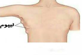 رایج ترین علائم لیپوم