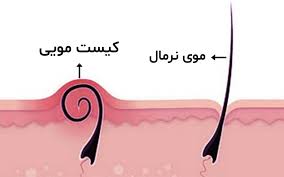 علائم کیست مویی
