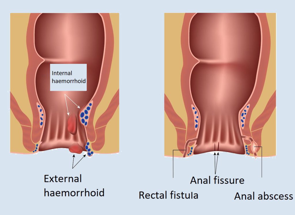 علائم آبسه مقعدی